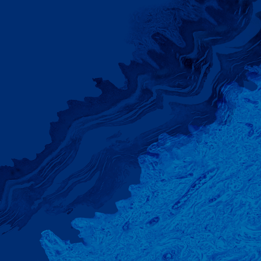 Breaking Ground - Melanoma Webinar